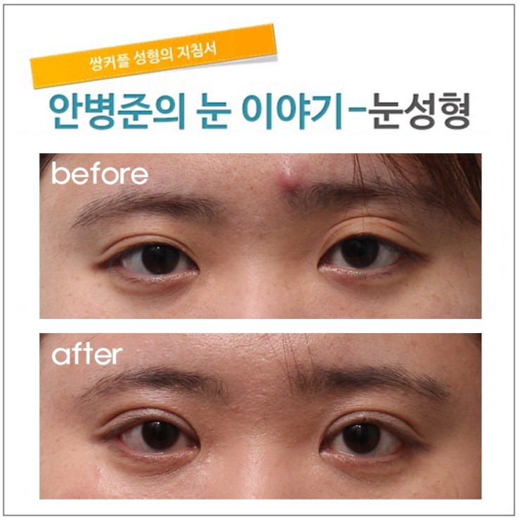 수술후 풀어지는 눈 관련 이미지 1
