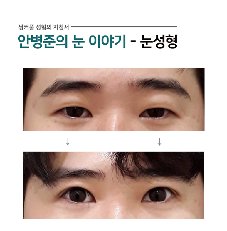 남자눈 일반적 수술방법 #1.(진짜 안검하수,피부절제,윗트임,가짜 안검하수) 관련 이미지 1
