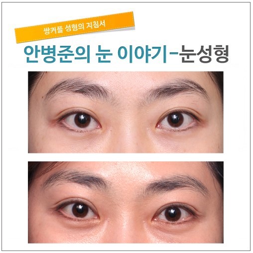 삼백안 고치기. 관련 이미지 1