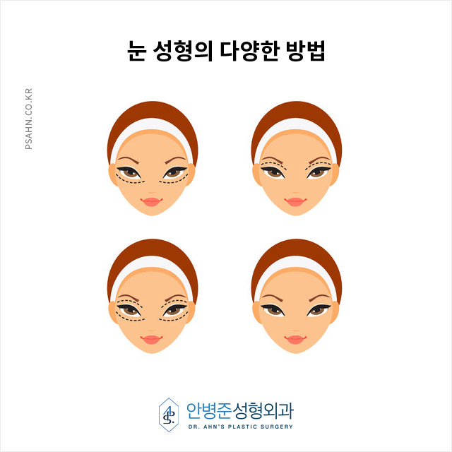 [눈성형]안병준성형외과전문의의 생각 - 쌍꺼풀 수술의 중요성 관련 이미지 4