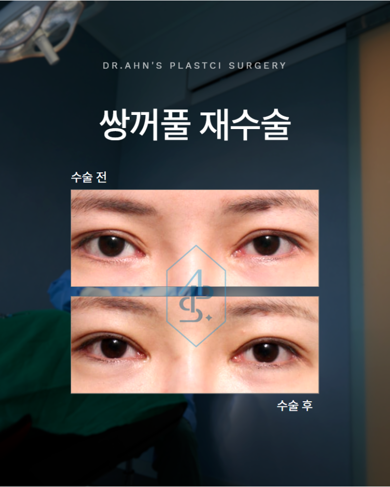 쌍꺼풀 재수술 여러 번 수술한 눈 어디서부터 다시 시작해야 할까요 관련 이미지 1