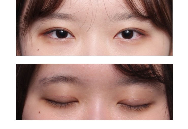 쌍꺼풀과 안검하수3개월후 관련 이미지 4