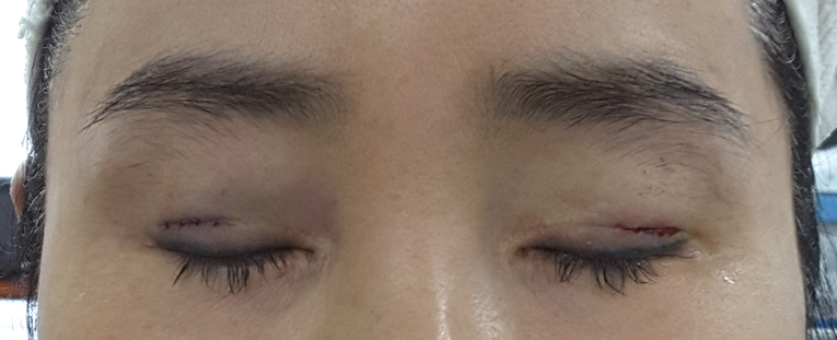 효과 좋은 지방이식 방법 관련 이미지 8