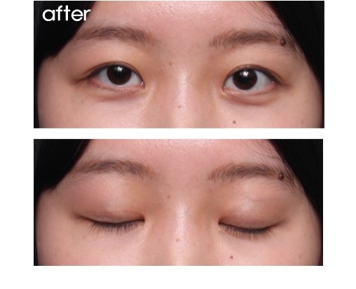 가짜 안검하수.(피부절제,쌍꺼풀수술,절개법) 관련 이미지 2