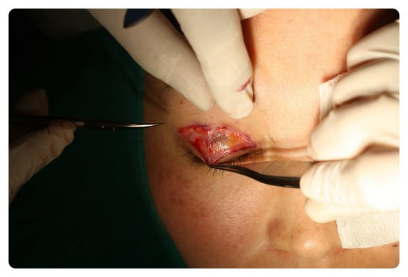 -소시지눈 고치기 과정-        [안병준의 눈이야기] 관련 이미지 5
