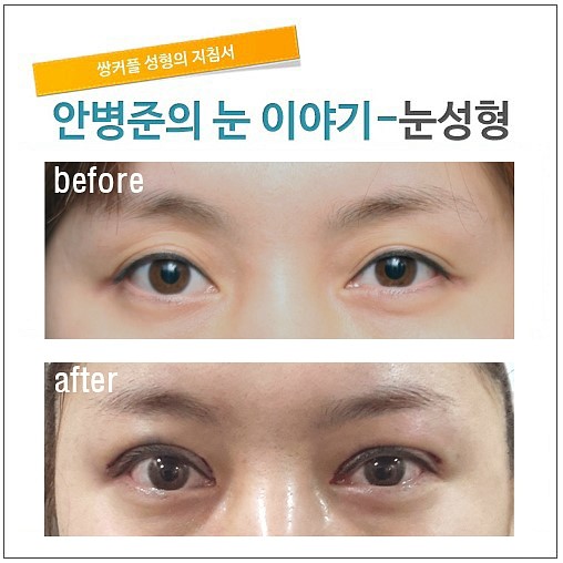 쌍꺼풀 재수술+지방이식+짝짝이 눈+겹주름 관련 이미지 1