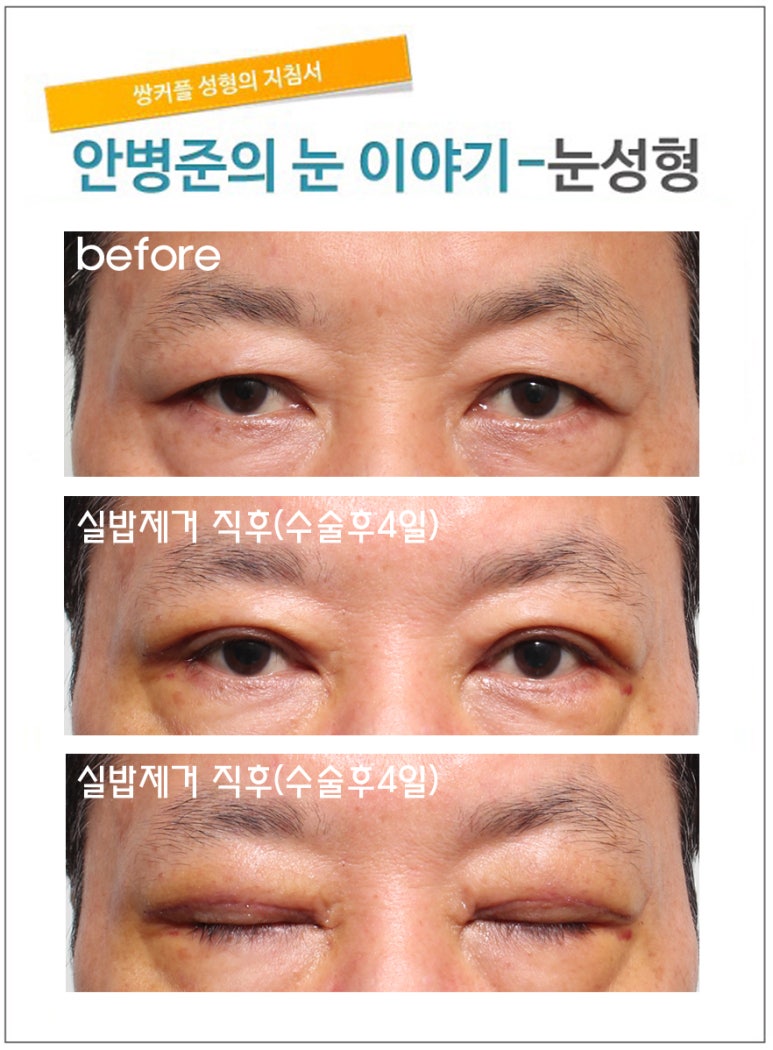 중년남성의 눈꺼풀 처짐 관련 이미지 1