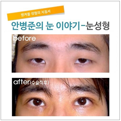 실밥 제거직후 관련 이미지 1