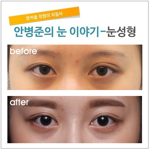 눈재수술 절개법 삼백안 교정(재수술,눈매교정) 관련 이미지 1