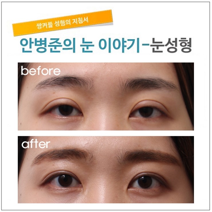 쌍꺼풀 수술후 눈뜨기가 더욱 불편해진 경우 관련 이미지 1