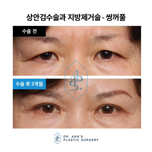 [눈성형] 쌍꺼풀 - 눈밑지방 제거 및 눈밑지방 재배치 관련 이미지 2