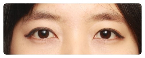 -자연스런 쌍꺼풀이 뭘까??-          [안병준의 눈이야기] 관련 이미지 2