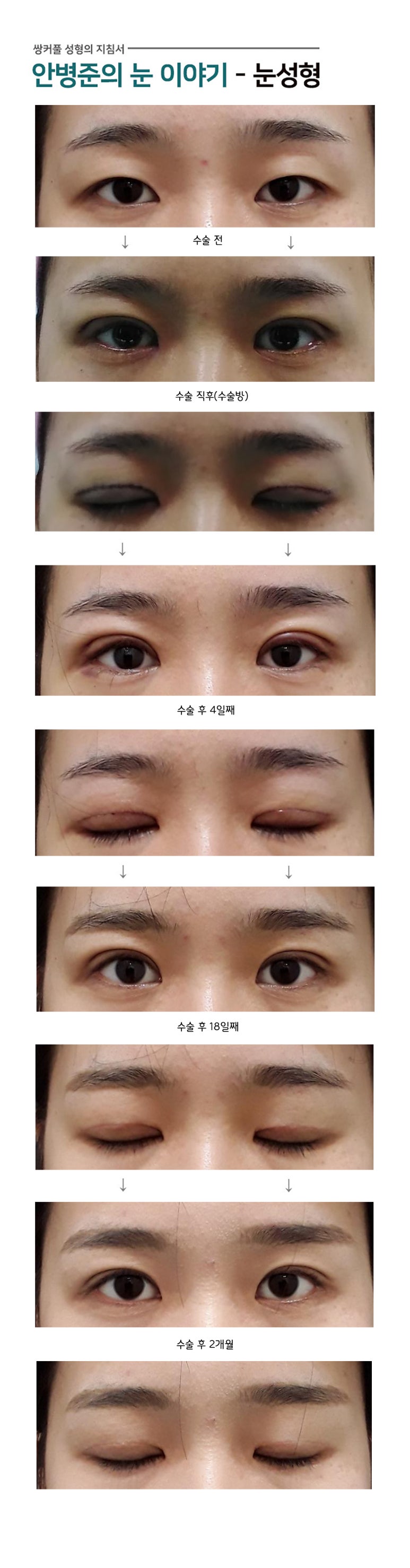 다이나믹 절개법(절개법,매몰법) 관련 이미지 1