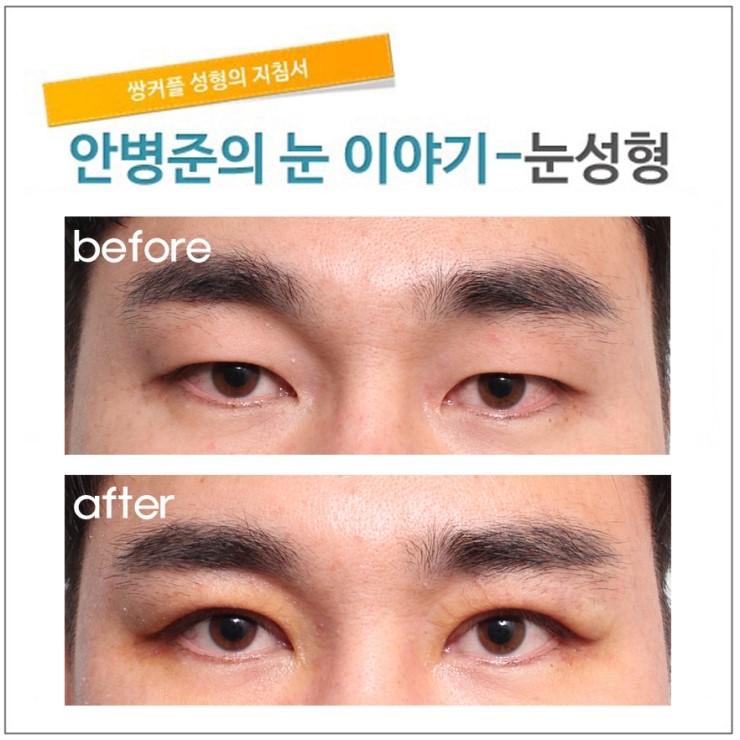 남자 쌍꺼풀 관련 이미지 1