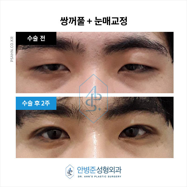 [남자쌍꺼풀]남성 안검하수, 답답함 벗고 활력을 되찾는 눈매 교정 관련 이미지 2