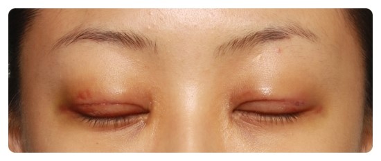 [안병준의 눈이야기]-안병준 성형외과 관련 이미지 3