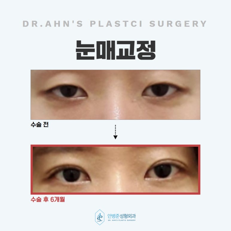 눈매교정 꺼진 눈은 교정하고, 쌍꺼풀은 더 자연스럽게 관련 이미지 5