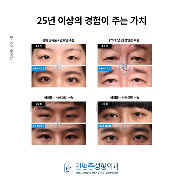 [눈성형]안병준성형외과전문의의 생각 - 쌍꺼풀 수술의 중요성 관련 이미지 2