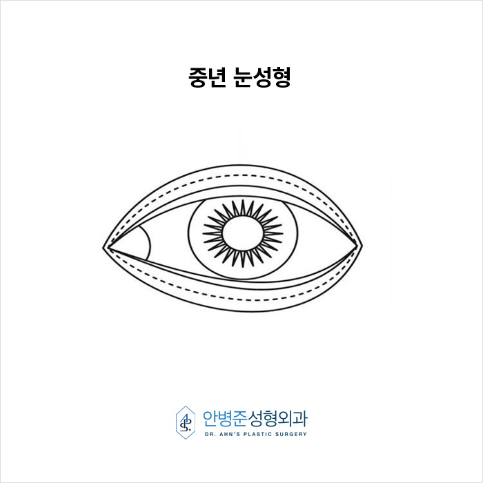 [중년눈성형] 과교정 피하고 자연스러운 동안 찾는 법 관련 이미지 5