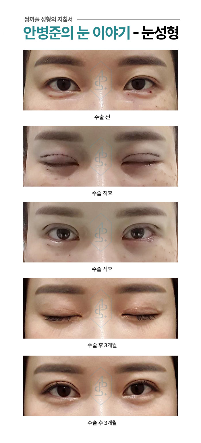 자연 쌍꺼풀이지만 나이가 들면 피부의 처짐 발생 관련 이미지 1