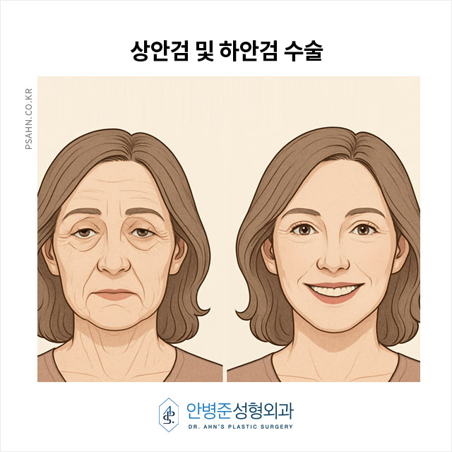 [중년눈성형] 중년 이후 눈 성형, 상안검과 하안검의 역할은? 관련 이미지 3