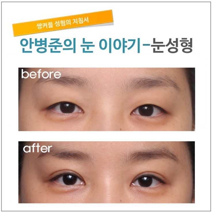 대표적인 단순 쌍꺼풀 수술.(쌍꺼풀수술,기본쌍꺼풀수술,자연스러운쌍꺼풀) 관련 이미지 1