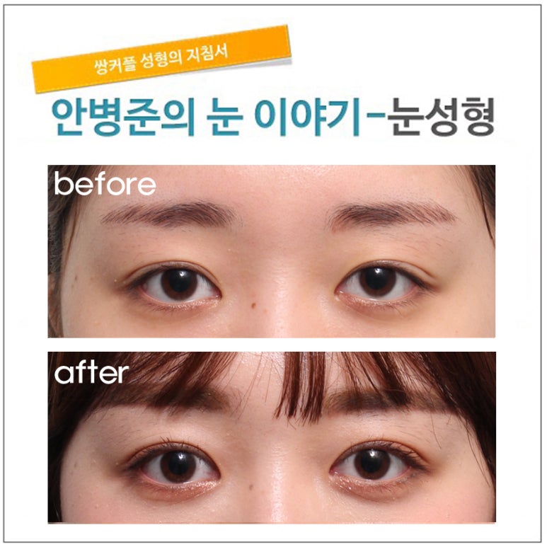 안검하수는 아닌데 삼백안 현상(삼백안,눈매교정) 관련 이미지 1