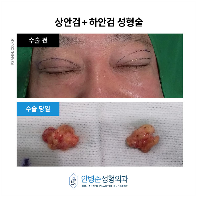 [상안검,하안검]100세 시대, 남성 상하안검성형술의 새로운 관심 관련 이미지 4
