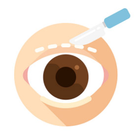 [눈성형]안병준성형외과전문의의 생각 - 쌍꺼풀 수술의 중요성 관련 이미지 3