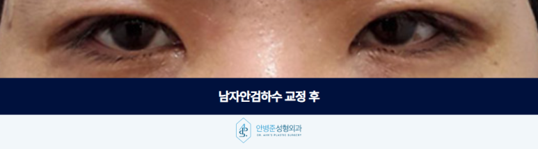 남자안검하수 눈이 처진 것 같다면 확인해야 할 것이 있습니다 관련 이미지 3