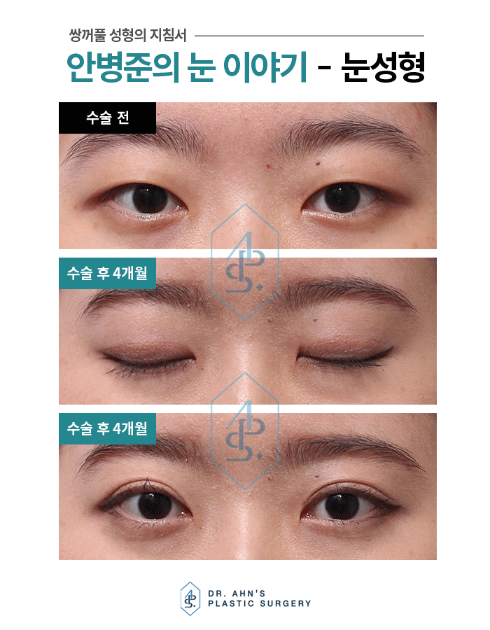 매몰, 부분절개등 쌍꺼풀수술 중 절개법(절제술) 사례 관련 이미지 1