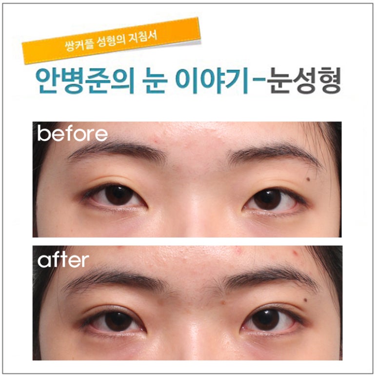 쌍꺼풀 수술후 3개월 경과(쌍꺼풀,절개법) 관련 이미지 2