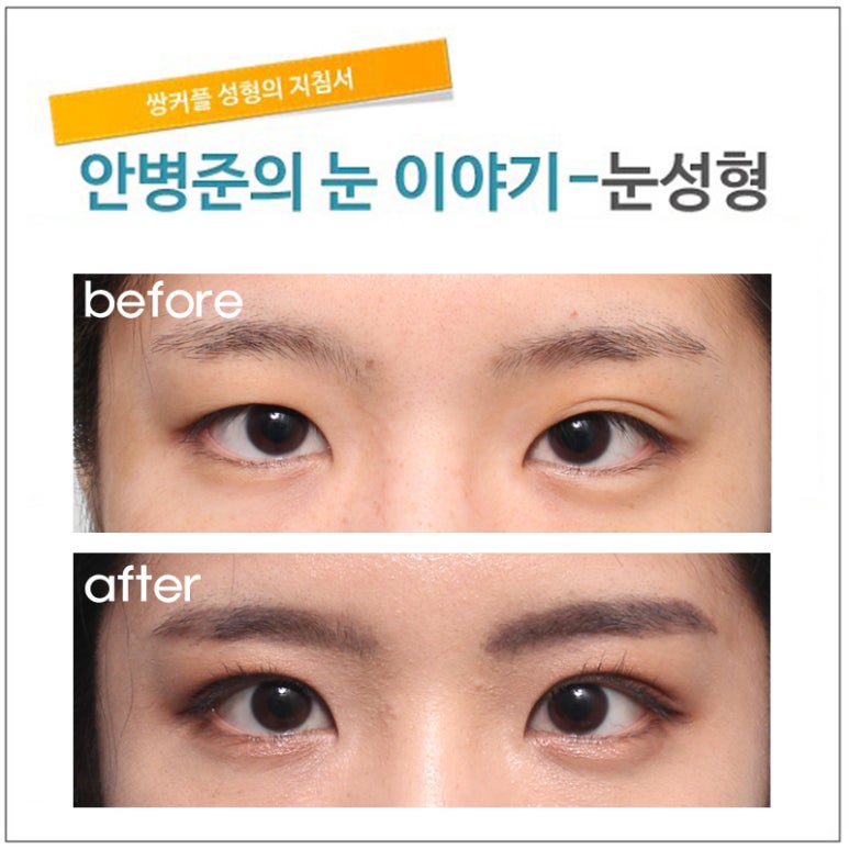 쌍꺼풀 수술후 3개월 경과(쌍꺼풀,절개법) 관련 이미지 1