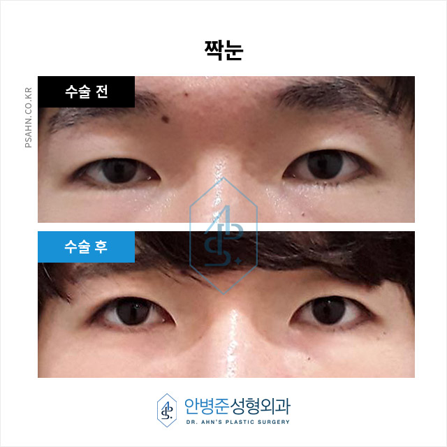 남성 쌍꺼풀 - 자연스러운 이미지 개선과 기능 회복 관련 이미지 5