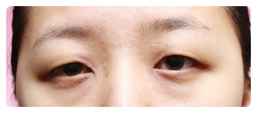 진짜 안검하수와 가짜 안검하수.(안검하수) 관련 이미지 2