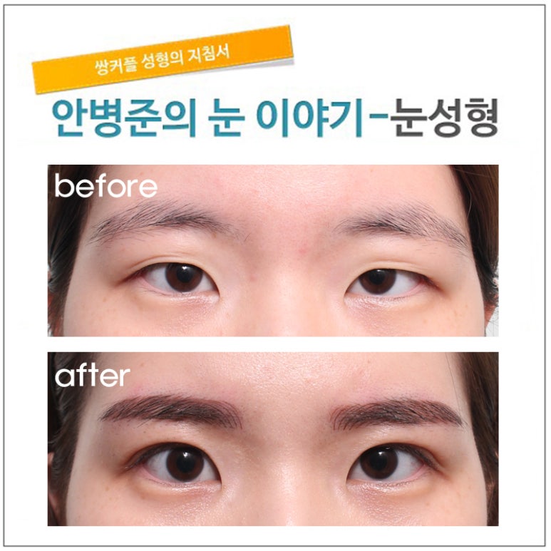 동양적인 눈(쌍꺼풀수술,피부제거) 관련 이미지 1