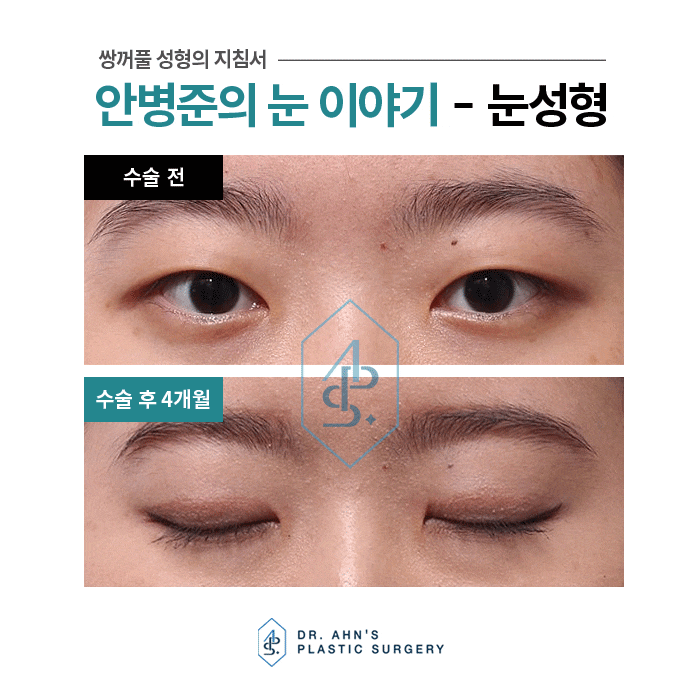 매몰, 부분절개등 쌍꺼풀수술 중 절개법(절제술) 사례 관련 이미지 2