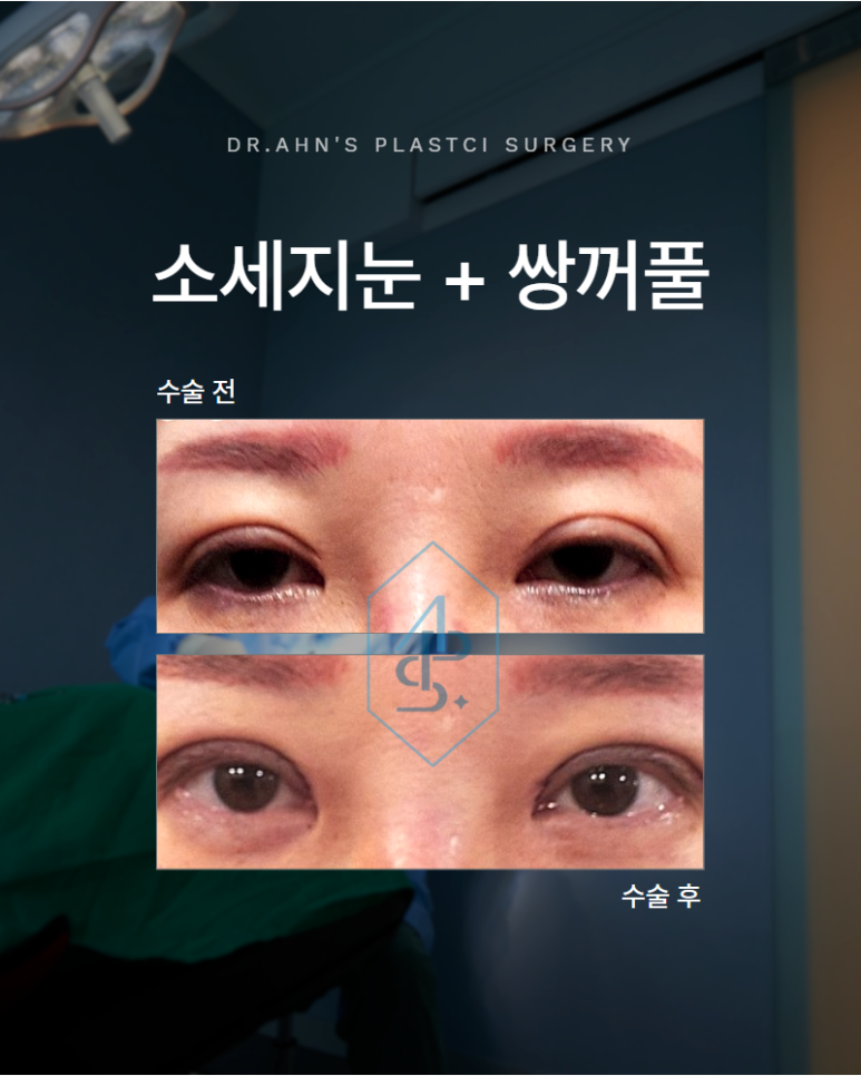 소세지눈 쌍꺼풀 크고 자연스러운 라인은 없습니다 관련 이미지 1