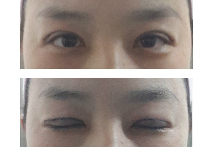 대표적인 단순 쌍꺼풀 수술.(쌍꺼풀수술,기본쌍꺼풀수술,자연스러운쌍꺼풀) 관련 이미지 2