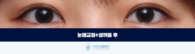 여자 눈매교정 안검하수 또렷하면서도 부드러운 인상을 찾다 관련 이미지 3