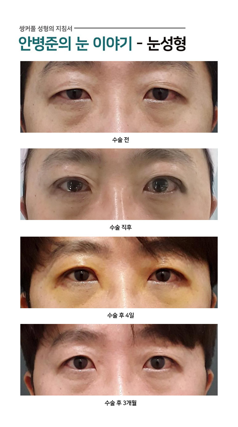 남자눈 짝눈 교정 - 짝눈 성형과 눈매교정 관련 이미지 1