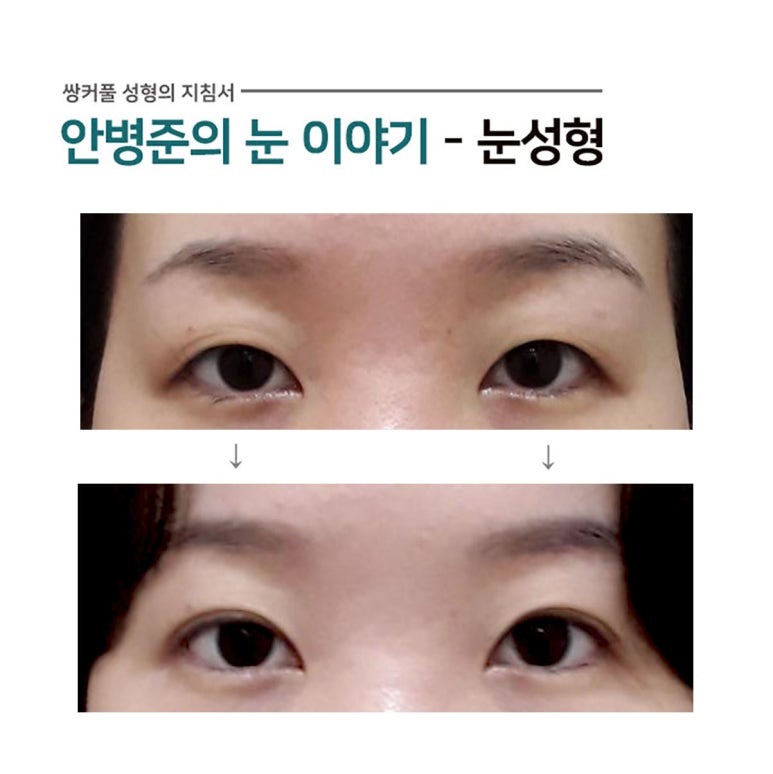 가장 보편적인 한국인의 눈(쌍꺼풀수술,쌍까풀수술,쌍수) 관련 이미지 1