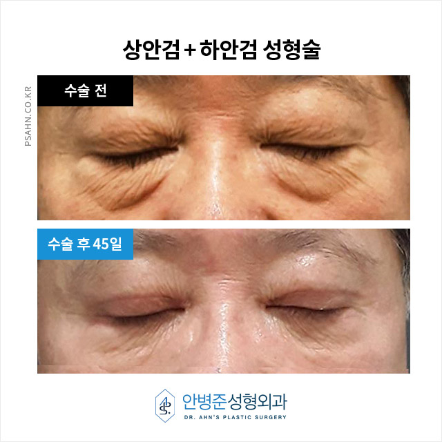 [상안검,하안검]100세 시대, 남성 상하안검성형술의 새로운 관심 관련 이미지 10