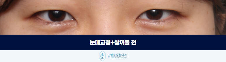 여자 눈매교정 안검하수 또렷하면서도 부드러운 인상을 찾다 관련 이미지 2