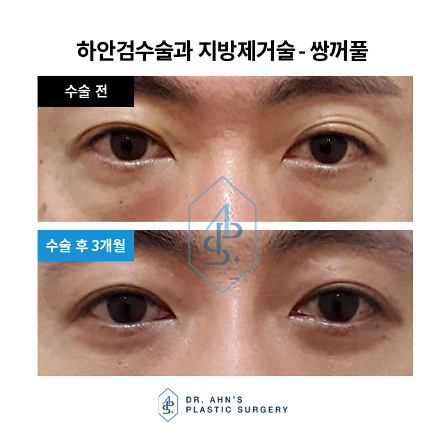 [눈성형] 쌍꺼풀 - 눈밑지방 제거 및 눈밑지방 재배치 관련 이미지 3