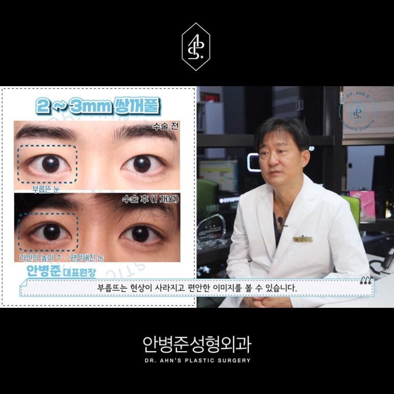 [남자성형외과] 남자 눈성형 쌍꺼풀수술 사례 모음 관련 이미지 5