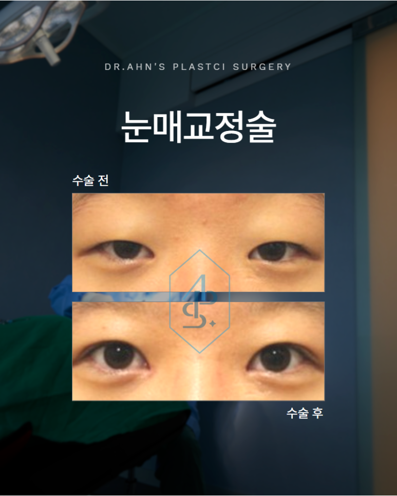 Ptosis Correction Surgery: If Your Eyebrows Are Raised, Improve Ptosis First image 1