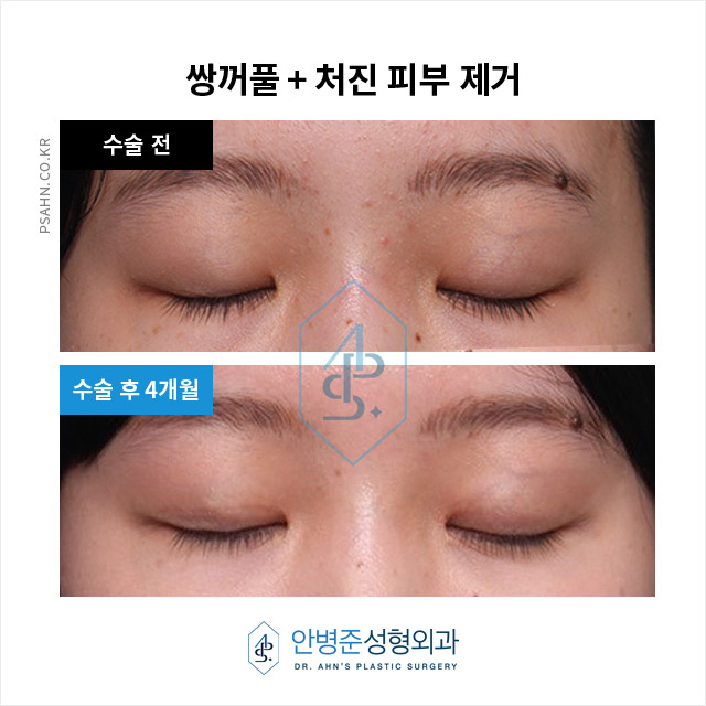 [눈성형] 가짜 안검하수, 불필요한 눈매교정 피하는 방법 관련 이미지 2