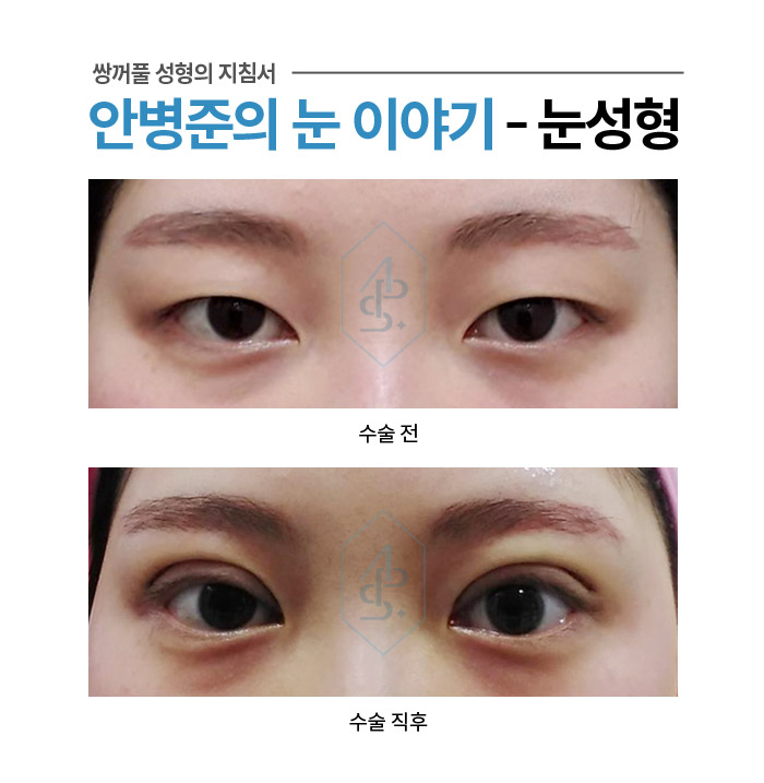 쌍꺼풀 수술에서 부기란? - 수술직후 붓기 사례 모음 관련 이미지 1