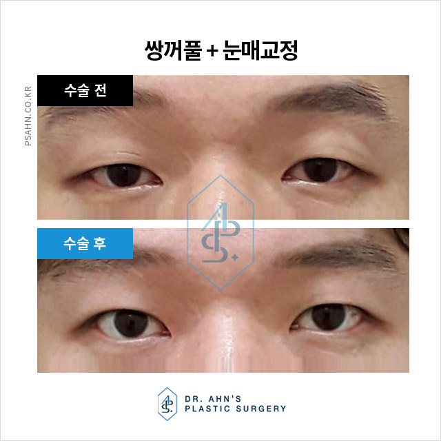 눈꺼풀 처짐 개선을 위한 수술, 어떤 방법이 있을까? 관련 이미지 3
